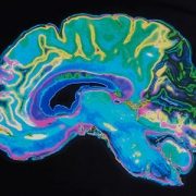 MRI image of a brain on a black background