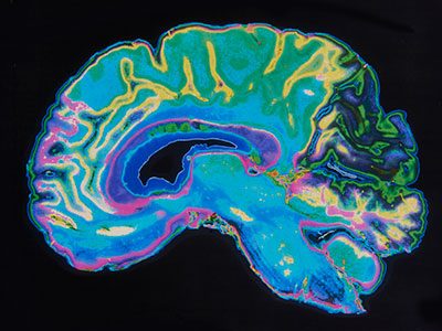 MRI image of a brain on a black background
