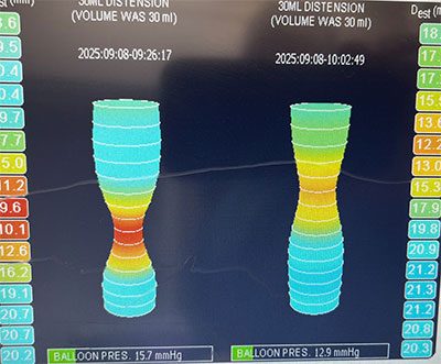endoFLIP displayed esophagogastric junction