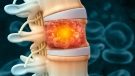 3D illustration of spine cancer