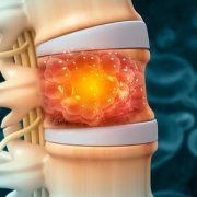 3D illustration of spine cancer