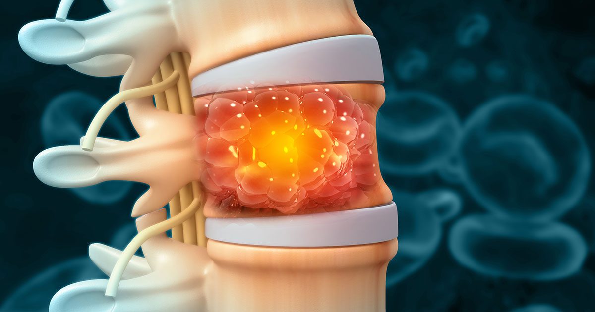 New insights into genetics of childhood brain and spinal tumors