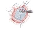 Anatomically accurate, illustrated image of atrioventricular septal defect repair