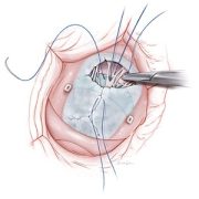 Anatomically accurate, illustrated image of atrioventricular septal defect repair