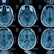brain scans