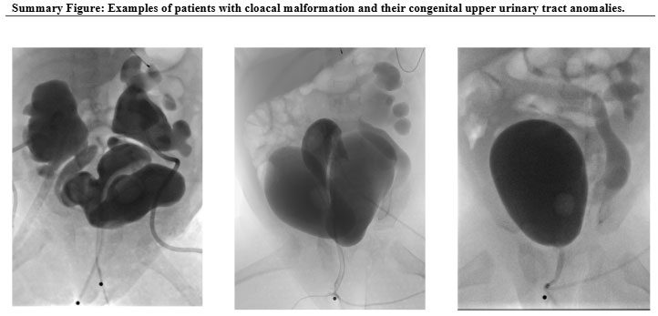 Examples of patients with cloacal malformation and their congenital upper urinary tract anomalies