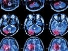 Scan of an inflamed brain.