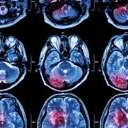 Scan of an inflamed brain.
