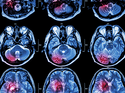 Scan of an inflamed brain.