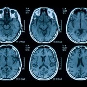 brain scans