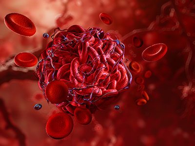 illustration of a blood clot