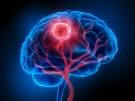 illustration of a brain tumor