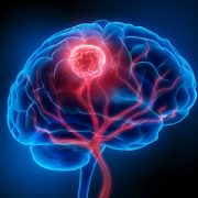 illustration of a brain tumor