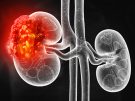 Conceptual image of kidney cancer progression
