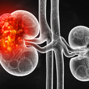 Conceptual image of kidney cancer progression